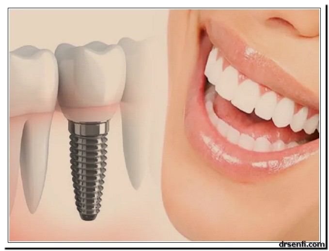 دندان چسبی بهتر است یا ایمپلنت کلینیک دندانپزشکی دکتر صنفی